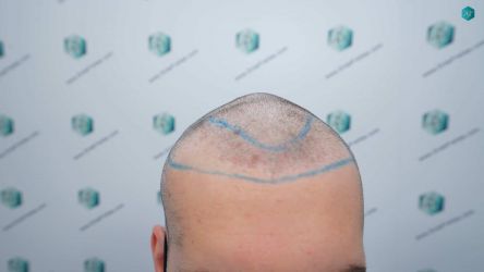 Injerto Capilar Técnica FUE Grafts 2117 (5025 Pelos) 11 13 LINEA DISENO INJERTO