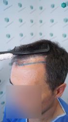 Injerto Capilar Técnica FUE Grafts 2945 (6960 Pelos) 14 14 DISENO LINEA INJERTO CAPILAR