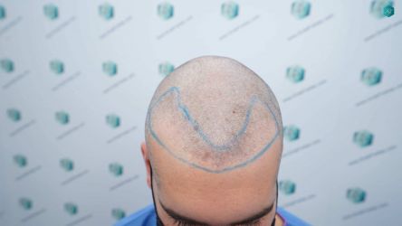 Injerto Capilar Técnica FUE Grafts 2117 (5025 Pelos) 12 14 LINEA DISENO INJERTO