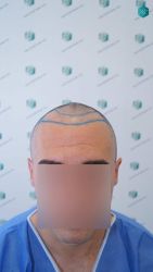 Injerto Capilar Técnica FUE Grafts 2945 (6960 Pelos) 15 15 DISENO LINEA INJERTO CAPILAR