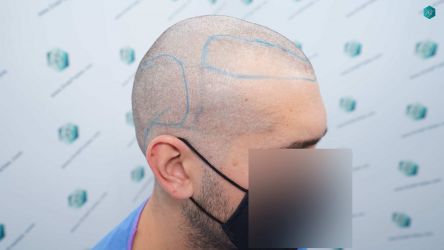Injerto Capilar Técnica FUE Grafts 2117 (5025 Pelos) 13 15 LINEA DISENO INJERTO