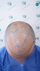 15A DISENO LINEA IMPLANTE