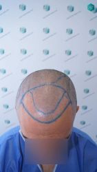 Injerto Capilar Técnica FUE Grafts 2945 (6960 Pelos) 16 15A DISENO LINEA INJERTO CAPILAR