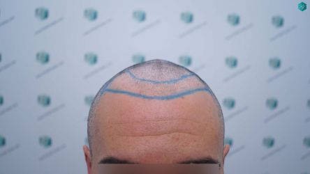 Injerto Capilar Técnica FUE Grafts 2945 (6960 Pelos) 17 16 DISENO LINEA INJERTO CAPILAR