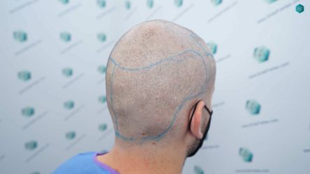 Injerto Capilar Técnica FUE Grafts 2117 (5025 Pelos) 14 16A LINEA DISENO INJERTO