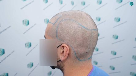 Injerto Capilar Técnica FUE Grafts 2117 (5025 Pelos) 15 16B LINEA DISENO INJERTO