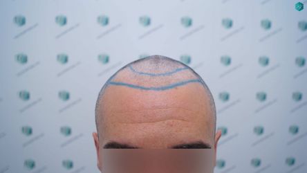 Injerto Capilar Técnica FUE Grafts 2945 (6960 Pelos) 18 17 DISENO LINEA INJERTO CAPILAR