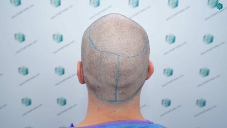 Injerto Capilar Técnica FUE Grafts 2117 (5025 Pelos) 16 17 LINEA DISENO INJERTO