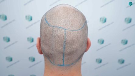 Injerto Capilar Técnica FUE Grafts 2117 (5025 Pelos) 17 18 LINEA DISENO INJERTO