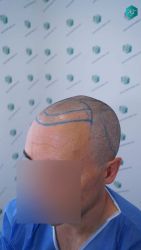 Injerto Capilar Técnica FUE Grafts 2945 (6960 Pelos) 20 19 DISENO LINEA INJERTO CAPILAR