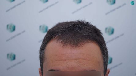 Injerto Capilar Técnica FUE Grafts 2945 (6960 Pelos) 1 2 ANTES DEL TRASPLANTE CAPILAR 2