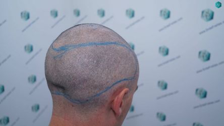 Injerto Capilar Técnica FUE Grafts 2945 (6960 Pelos) 21 20 DISENO LINEA DE INJERTO CAPILAR