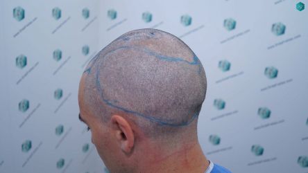 Injerto Capilar Técnica FUE Grafts 2945 (6960 Pelos) 22 21 DISENO LINEA DE INJERTO CAPILAR