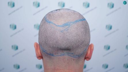 Injerto Capilar Técnica FUE Grafts 2945 (6960 Pelos) 23 22 DISENO LINEA DE INJERTO CAPILAR