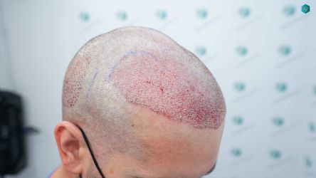 Injerto Capilar Técnica FUE Grafts 2117 (5025 Pelos) 20 22 TRASPLANTE CAPILAR 1