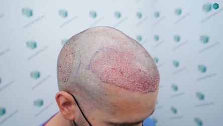 Injerto Capilar Técnica FUE Grafts 2117 (5025 Pelos) 21 22A TRASPLANTE CAPILAR 1