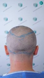 Injerto Capilar Técnica FUE Grafts 2945 (6960 Pelos) 24 23 DISENO LINEA DE INJERTO