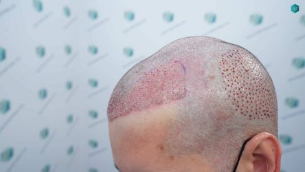 Injerto Capilar Técnica FUE Grafts 2117 (5025 Pelos) 23 23A TRASPLANTE CAPILAR