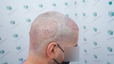 Injerto Capilar Técnica FUE Grafts 2117 (5025 Pelos) 25 25 TRASPLANTE CAPILAR 1