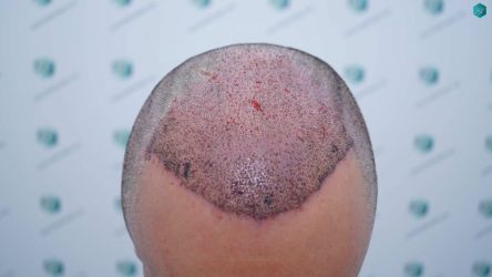 Injerto Capilar Técnica FUE Grafts 2945 (6960 Pelos) 25 25 TRASPLANTE CAPILAR 2