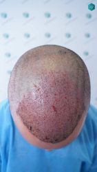 Injerto Capilar Técnica FUE Grafts 2945 (6960 Pelos) 26 25A TRASPLANTE CAPILAR