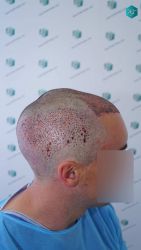 Injerto Capilar Técnica FUE Grafts 2945 (6960 Pelos) 27 26 TRASPLANTE CAPILAR 1