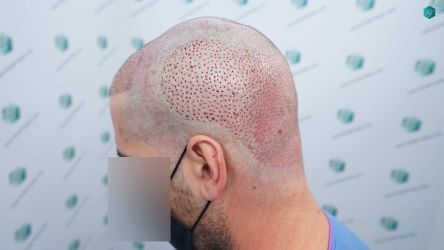 Injerto Capilar Técnica FUE Grafts 2117 (5025 Pelos) 26 26 TRASPLANTE CAPILAR