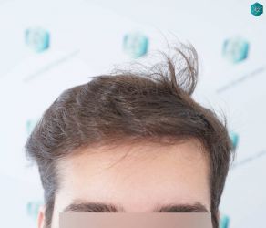 Injerto Capilar Técnica FUE Grafts 2117 (5025 Pelos) 27 27 RESULTADOS A LOS 12 MESES 1