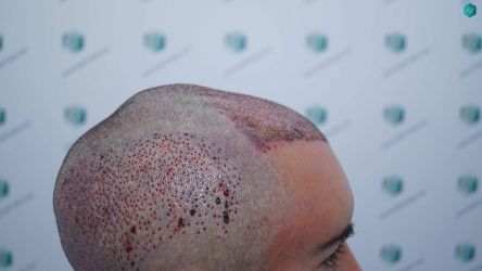 Injerto Capilar Técnica FUE Grafts 2945 (6960 Pelos) 28 27 TRASPLANTE CAPILAR