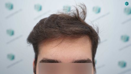 Injerto Capilar Técnica FUE Grafts 2117 (5025 Pelos) 28 28 RESULTADOS A LOS 12 MESES