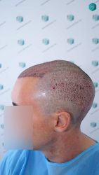 Injerto Capilar Técnica FUE Grafts 2945 (6960 Pelos) 29 28 TRASPLANTE CAPILAR