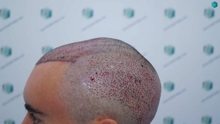 Injerto Capilar Técnica FUE Grafts 2945 (6960 Pelos) 30 29 TRASPLANTE CAPILAR