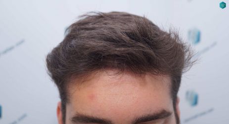 Injerto Capilar Técnica FUE Grafts 2117 (5025 Pelos) 30 29A RESULTADOS A LOS 12 MESES