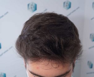 Injerto Capilar Técnica FUE Grafts 2117 (5025 Pelos) 31 29AA RESULTADOS A LOS 12 MESES