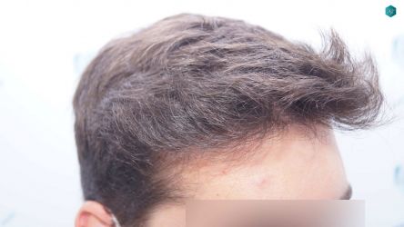 Injerto Capilar Técnica FUE Grafts 2117 (5025 Pelos) 32 29AAA RESULTADOS A LOS 12 MESES
