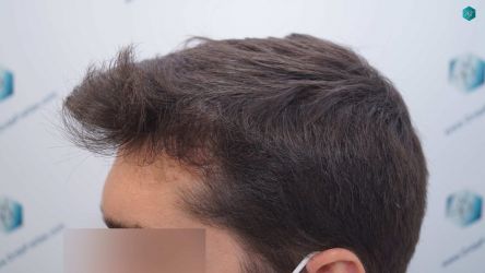 Injerto Capilar Técnica FUE Grafts 2117 (5025 Pelos) 33 29B RESULTADOS A LOS 12 MESES