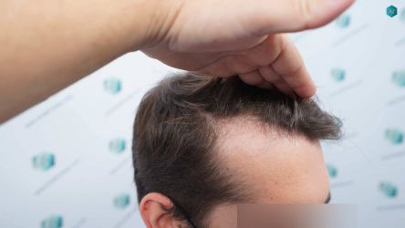 Injerto Capilar Técnica FUE Grafts 2117 (5025 Pelos) 2 3 ANTES DEL TRASPLANTE CAPILAR 1
