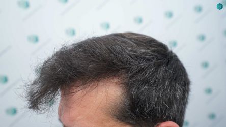 30 RESULTADOS A LOS 12 MESES