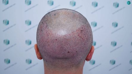 Injerto Capilar Técnica FUE Grafts 2945 (6960 Pelos) 31 30 TRASPLANTE CAPILAR