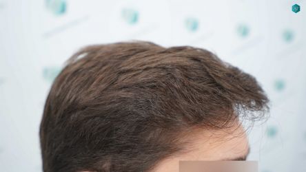 Injerto Capilar Técnica FUE Grafts 2117 (5025 Pelos) 35 31 RESULTADOS A LOS 12 MESES 1