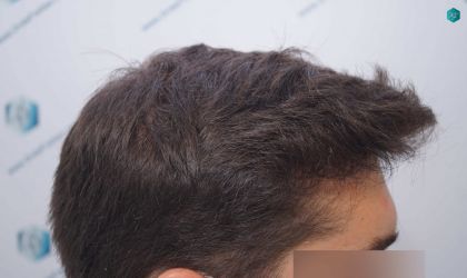 Injerto Capilar Técnica FUE Grafts 2117 (5025 Pelos) 36 31A RESULTADOS A LOS 12 MESES
