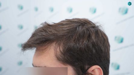Injerto Capilar Técnica FUE Grafts 2117 (5025 Pelos) 37 32 RESULTADOS A LOS 12 MESES 1