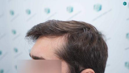 Injerto Capilar Técnica FUE Grafts 2117 (5025 Pelos) 38 32A RESULTADOS A LOS 12 MESES
