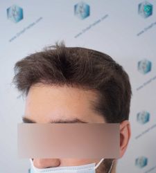 Injerto Capilar Técnica FUE Grafts 2117 (5025 Pelos) 39 32AB RESULTADOS A LOS 12 MESES