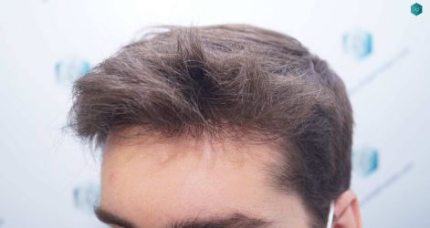 Injerto Capilar Técnica FUE Grafts 2117 (5025 Pelos) 40 32ABC RESULTADOS A LOS 12 MESES