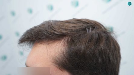 Injerto Capilar Técnica FUE Grafts 2117 (5025 Pelos) 41 32B RESULTADOS A LOS 12 MESES
