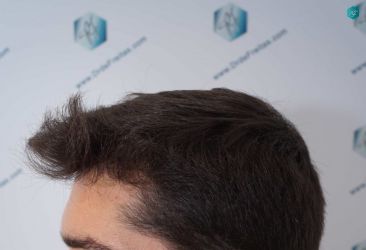 Injerto Capilar Técnica FUE Grafts 2117 (5025 Pelos) 42 32BB RESULTADOS A LOS 12 MESES
