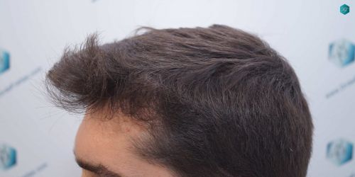 Injerto Capilar Técnica FUE Grafts 2117 (5025 Pelos) 43 32BCC RESULTADOS A LOS 12 MESES