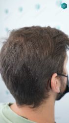 Injerto Capilar Técnica FUE Grafts 2117 (5025 Pelos) 44 33 RESULTADOS A LOS 12 MESES 1