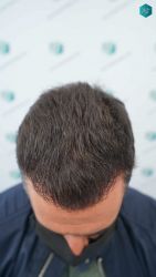 Injerto Capilar Técnica FUE Grafts 2945 (6960 Pelos) 33 33A RESULTADOS A LOS 12 MESES